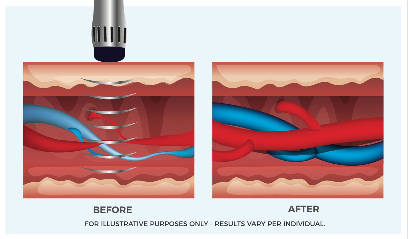Shockwave therapy